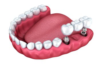 A 3d model of implant-supported dental bridge